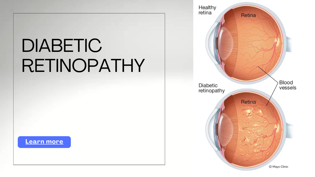 What is Diabetic Retinopathy?